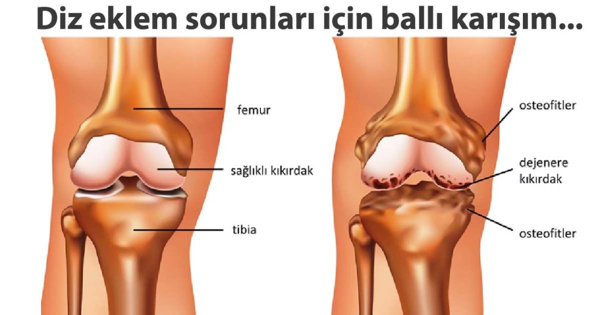 Diz Eklem Ağrılarına Doğal Karışım