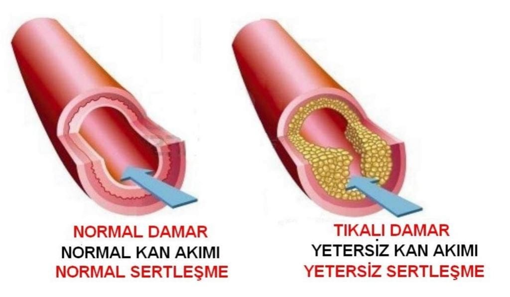 Kapalı Damarları Açan Kür Tarifi